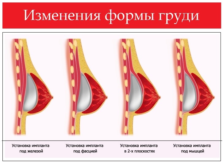 Обвисла Грудь Фото Девушек